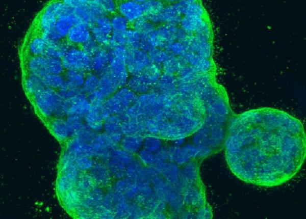 la ce sa te a tep i de la o biopsie mamara