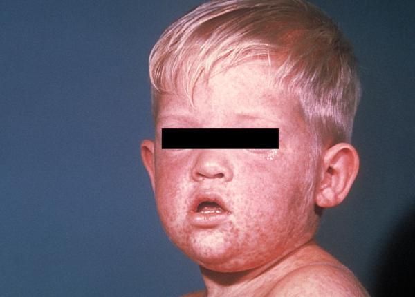 bilan rujeola romania inca 12 cazuri intr o saptamana