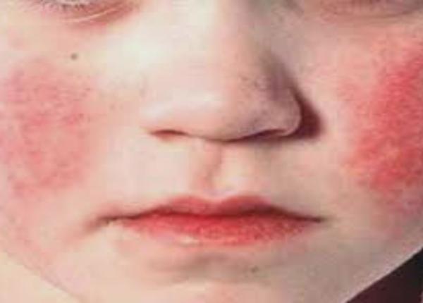 rujeola un caz fatal arata importan a imunita ii de grup prin vaccinare