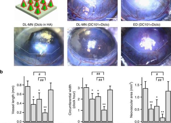 lentile de contact medicament pentru boli oculare