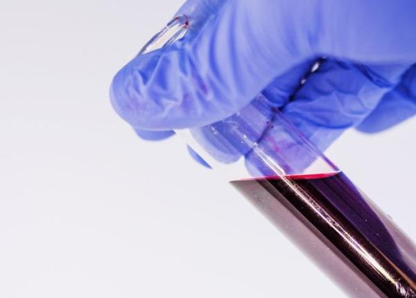 cancer ovarian test de sange care il detecteaza in faza incipienta