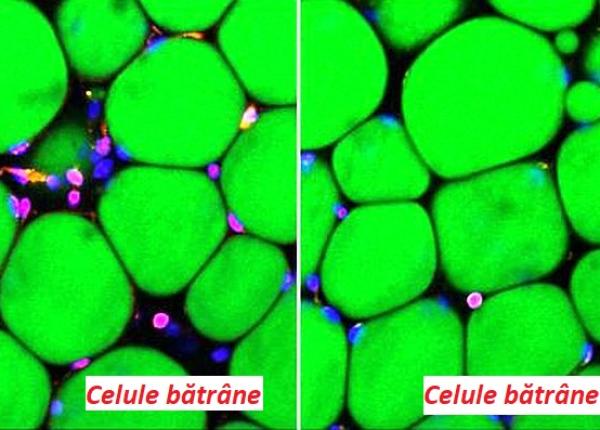 alzheimer un medicament pentru hiv ar putea trata boala