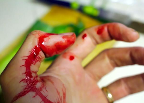 cum opre ti o sangerare puternica sfatul unui medic de la urgen a