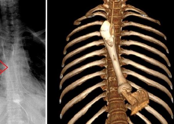 stent esofagian caz complicat la spitalul universitar din bucure ti