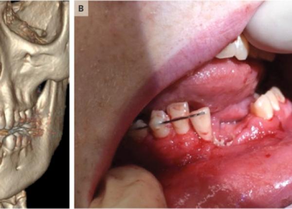 tigareta electronica pericol tanar cu fa a distrusa din cauza exploziei