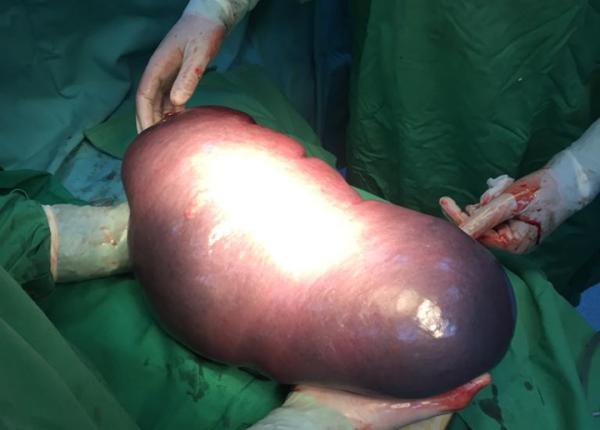 splina gigant operata la spitalul jude ean din baia mare