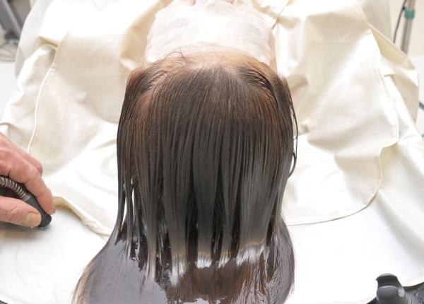 alopecia tratament terapia vampir i mezoterapia solu ii pentru caderea parului