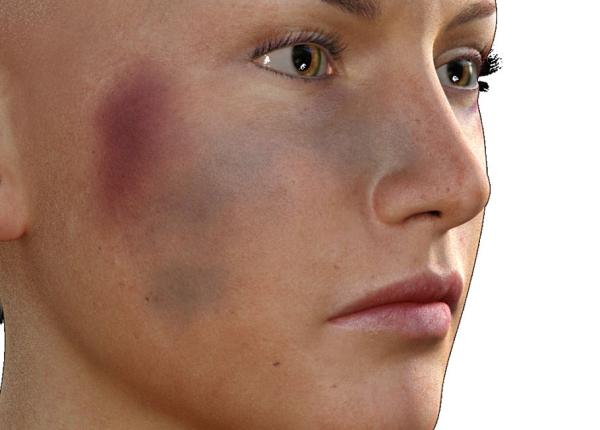 vanataile de ce apar i cum le tratezi