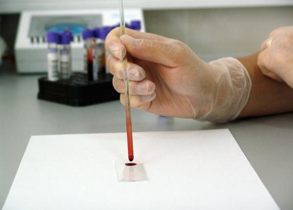 cancerul de sange risc mai mare daca ai rude afectate de boala cancerul de sange risc mai mare daca ai rude afectate de boala