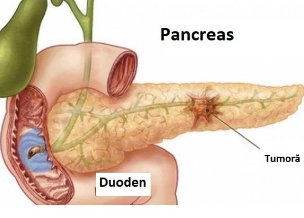 cancer pancreatic mai aproape de tratarea lui ultimele descoperiri