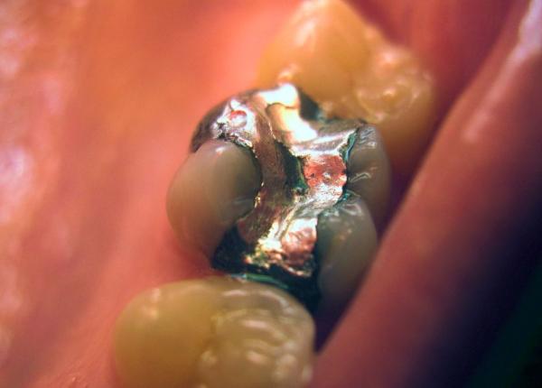plombele din amalgam cu mercur scoase treptat din cabinetele stomatologice milioane de persoane afectate