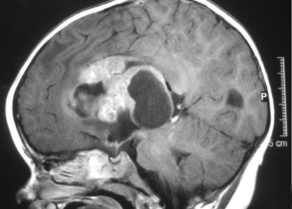 cum recunosti simptomele unei tumori cerebrale primul semn durerile de cap