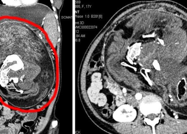 caz medical rar tanara care a trait xxx ani avand in abdomen resturi din fratele parazitar