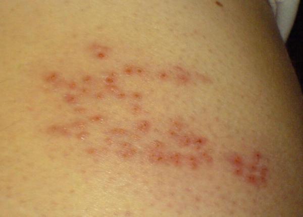 zona zoster simptome si diagnostic