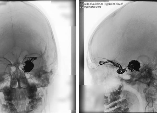 interventie complicata procedura minim invaziva la un pacient cu o trauma oculara interventie complicata procedura minim invaziva la un pacient cu o trauma oculara