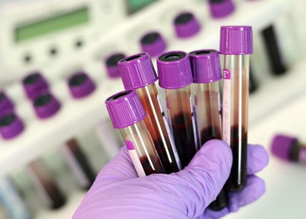 leucemia mieloida acuta forma de cancer care incepe din maduva oaselor leucemia mieloida acuta forma de cancer care incepe din maduva oaselor