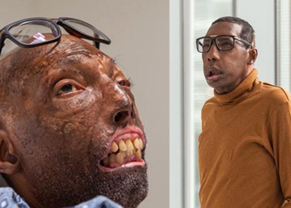 transplant de fa a primul barbat afro american i cel mai batran pacient operat