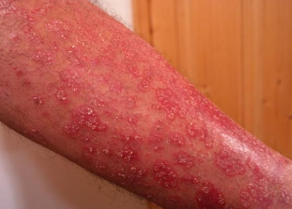 psoriazisul ar putea cre te riscul de cancer