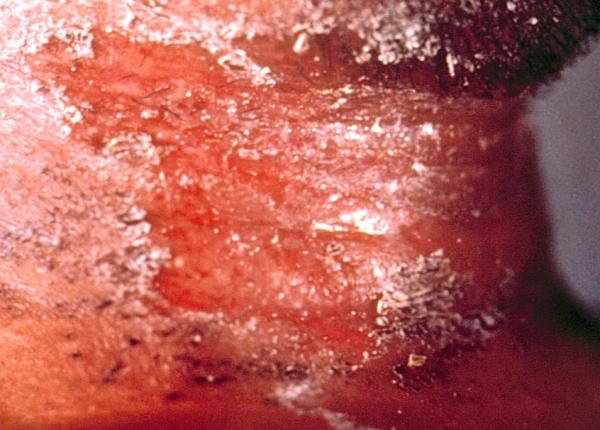 difteria in ucraina amenin are epidemica langa romania