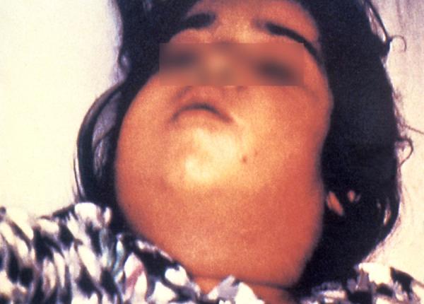 ucraina masuri contra difteriei 21 de cazuri sute de doze de vaccin