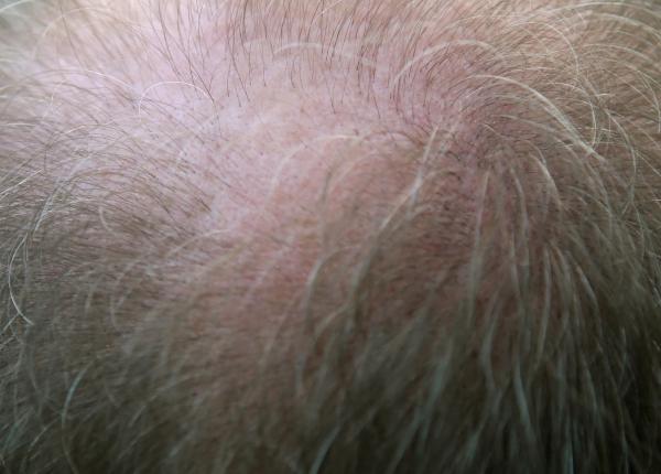 unele tipuri de cancer de piele pot incepe in foliculii de par