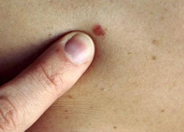 cancerul de piele cum se formeaza descoperire remarcabila a cercetatorilor