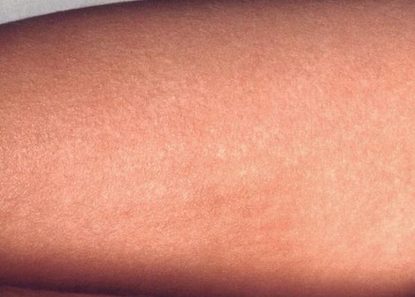 trei cazuri de scarlatina la o coala din draga ani