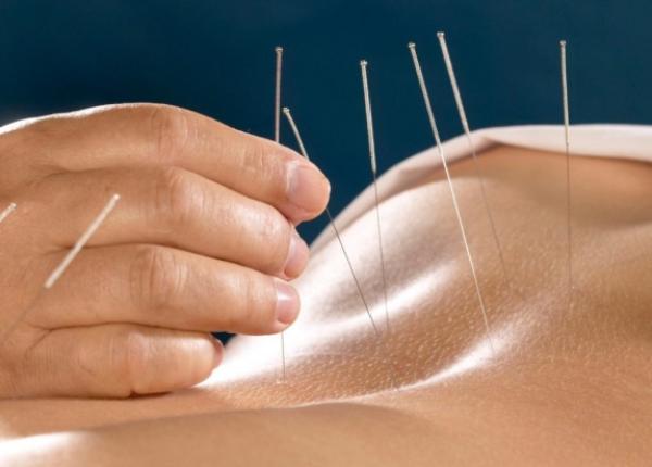 acupunctura efect in reducerea durerilor in special a celor cauzate de cancer