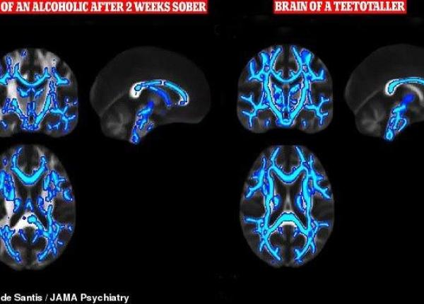dependenta de alcool produce modificari in creier comparabile cu boala alzheimer