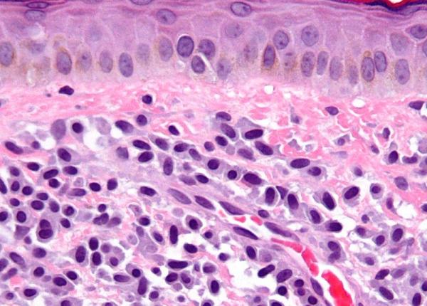 mastocitoza sorina pintea al doilea centru de excelen a din romania infiin at la baia mare