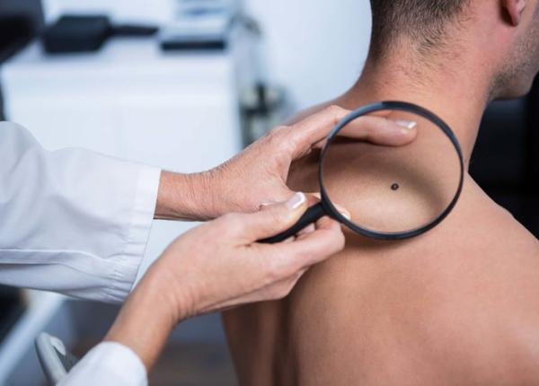 melanomul malign tot ce ar trebui sa ti i despre el melanomul malign tot ce ar trebui sa ti i despre el