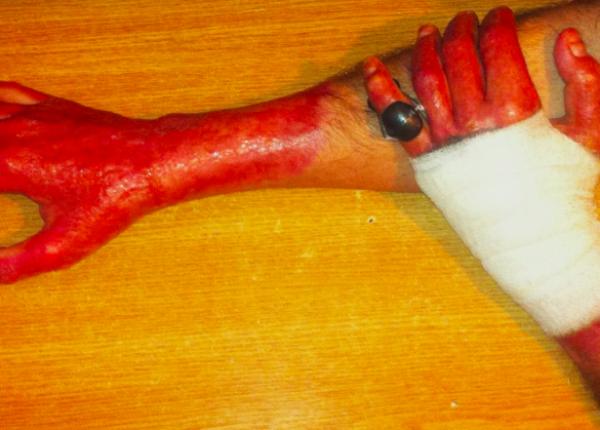 sprijin financiar pentru plata tratamentelor pe toata durata vie ii pentru victimele de la colectiv