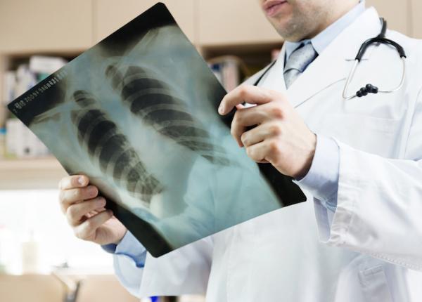 cancerul pulmonar mai frecvent la femei in trecut raportul era invers