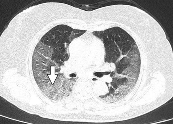 pneumonia data de coronavirus cum afecteaza plamanii constatari facute la ct