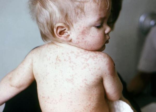 rujeola 119 cazuri noi raportate saptamana trecuta