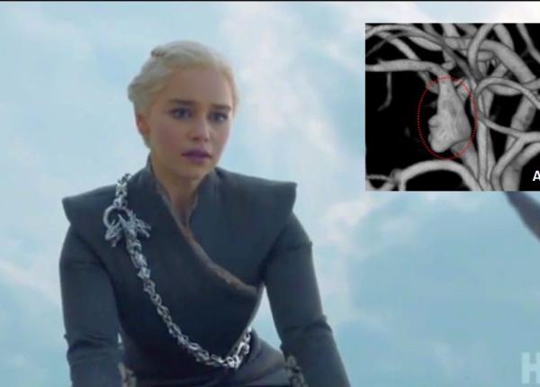 medicamente pentru cancer tratament pentru anevrism cerebral