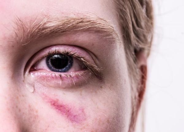 sindromul ochiului uscat ce este i care sunt simptomele sindromul ochiului uscat ce este i care sunt simptomele