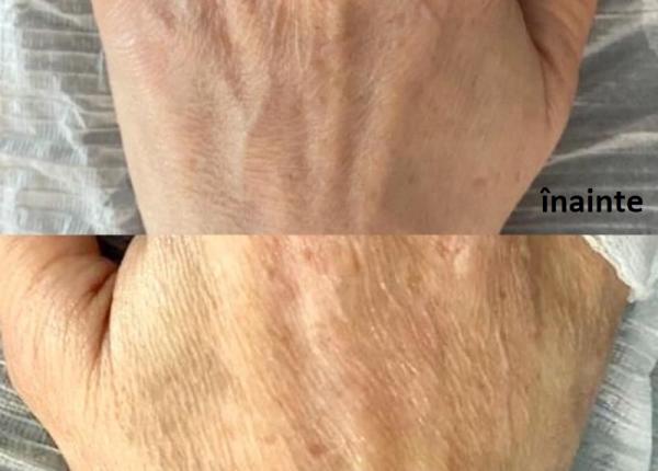 mainile imbatranite cu vene la vedere uite cum le faci sa arate tinere