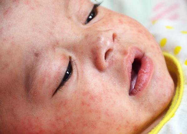 ara care a scapat de rujeola dupa ce peste 7 000 de copii au murit in doi ani de epidemie