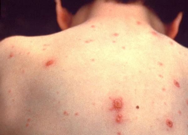 vaccin de ultima genera ie impotriva varicelei tot ce trebuie sa tii despre el