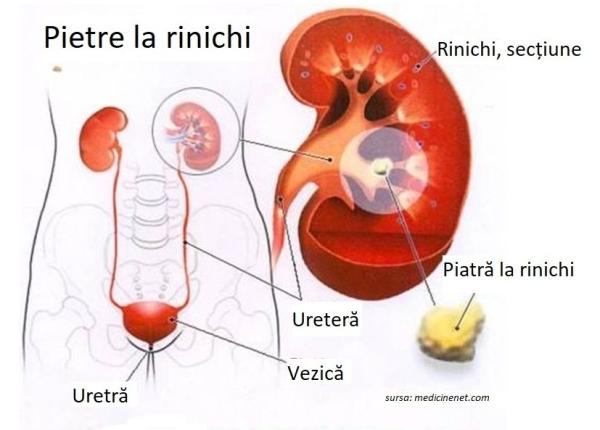 pietre la rinichi simptomele care nu pot fi confundate cu nimic pietre la rinichi simptomele care nu pot fi confundate cu nimic