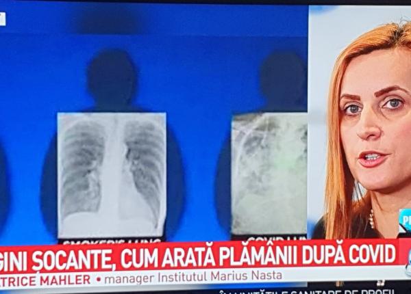 imagini socante cum arata plamanii dupa covid 19 beatrice mahler impact foarte mare