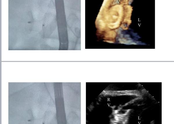 procedura rara salvatoare de vieti la c c iliescu dr dan deleanu sunt printre cele mai grele interventii din cardiologia interventionala