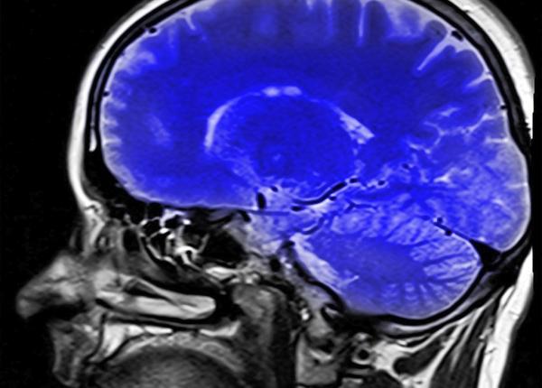 pacientii cu covid 19 risc mai mare de accident vascular cerebral cum explica medicii