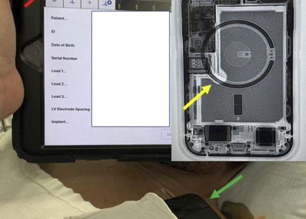 alarmant iphone 12 periculos pentru cardiacii cu aritmii maligne care au implantate defibrilatoare primul raport publicat
