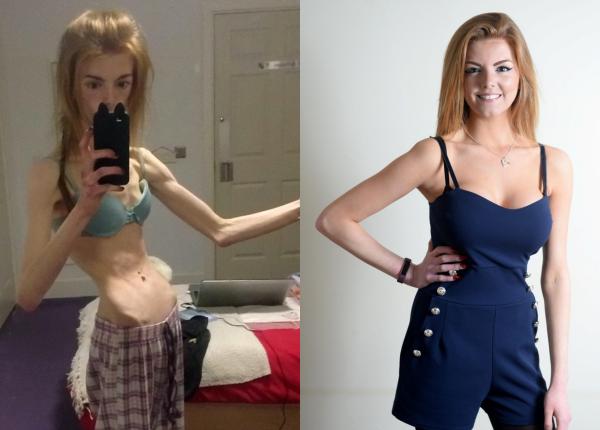 soc in lumea medicala a mancat o felie de paine pe zi timp de 5 ani asa a ajuns sa cantareasca doar 29 kg