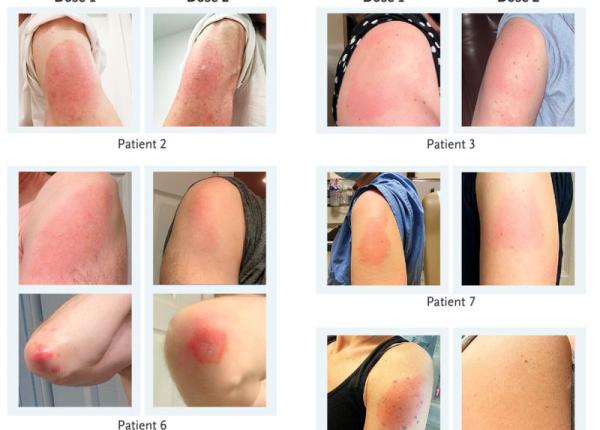 vaccinul moderna nou efect secundar apare pe piele si poate fi confundat cu o alta boala