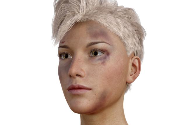 3 remedii rapide pentru vanatai cand sunt vanataile o problema grava