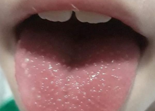 limba de culoarea zmeurei la copii ce tradeaza simptomul explica pediatrul mihai craiu limba de culoarea zmeurei la copii ce tradeaza simptomul explica pediatrul mihai craiu