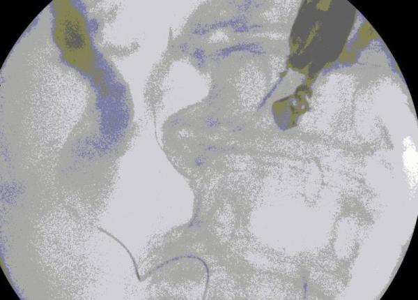 pacienta cu cancer pancreatic avansat si infectata cu covid 19 interventie premiera nationala la spitalul colentina